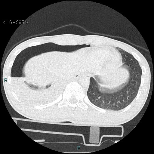 Blunt chest trauma (Swiss cheese sign) (Radiopaedia 38519-40618 Axial lung window 68).jpg