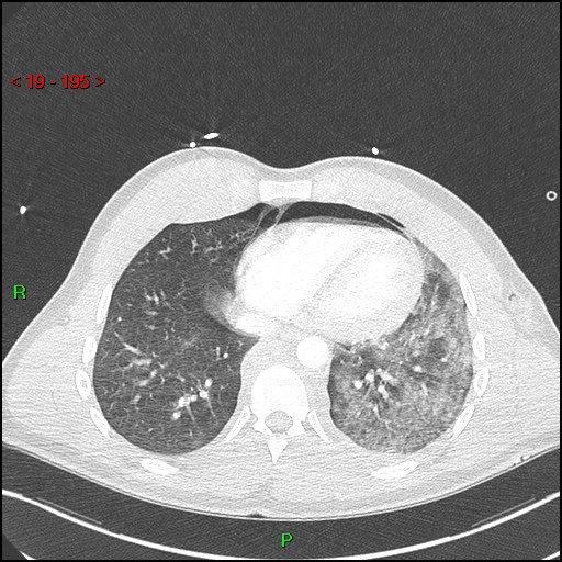 Blunt thoracic trauma (Radiopaedia 73454-84221 Axial lung window 71).jpg