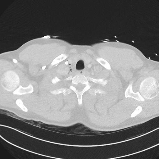 File:Boerhaave syndrome (Radiopaedia 39382-41660 Axial lung window 4).png