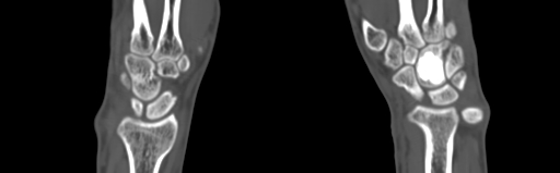 Bone islands - carpus (Radiopaedia 63141-71658 Coronal bone window 33).jpg