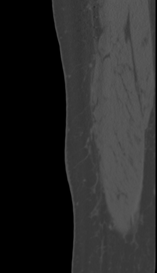 Bone metastasis - tibia (Radiopaedia 57665-64609 Sagittal bone window 13).jpg