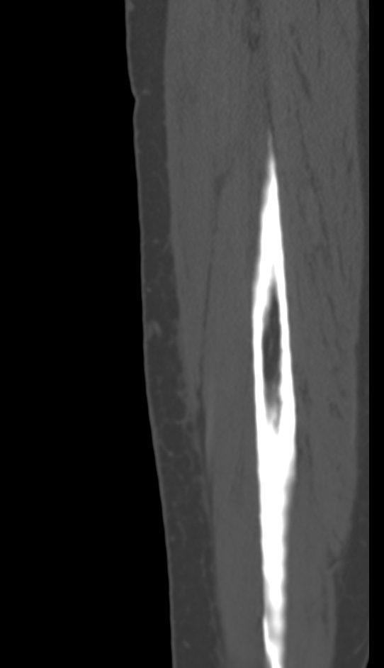 Bone metastasis - tibia (Radiopaedia 57665-64609 Sagittal bone window 166).jpg
