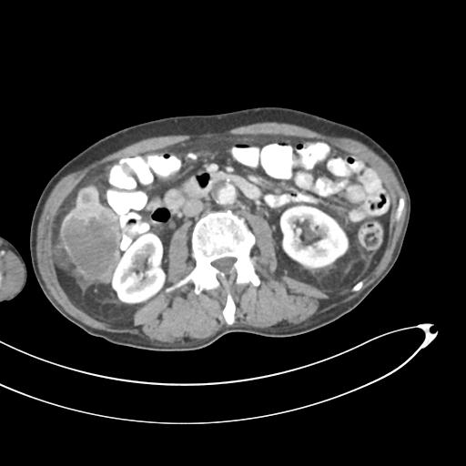 Bone metastasis from squamous cell carcinoma (Radiopaedia 30133-30730 B 34).jpg