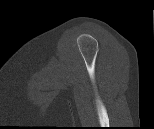 Bony Bankart and Hill-Sachs lesions (Radiopaedia 33622-34727 Sagittal bone window 15).png