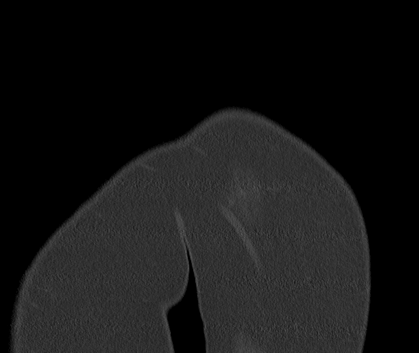 Bony Bankart and Hill-Sachs lesions (Radiopaedia 33622-34727 Sagittal bone window 3).png