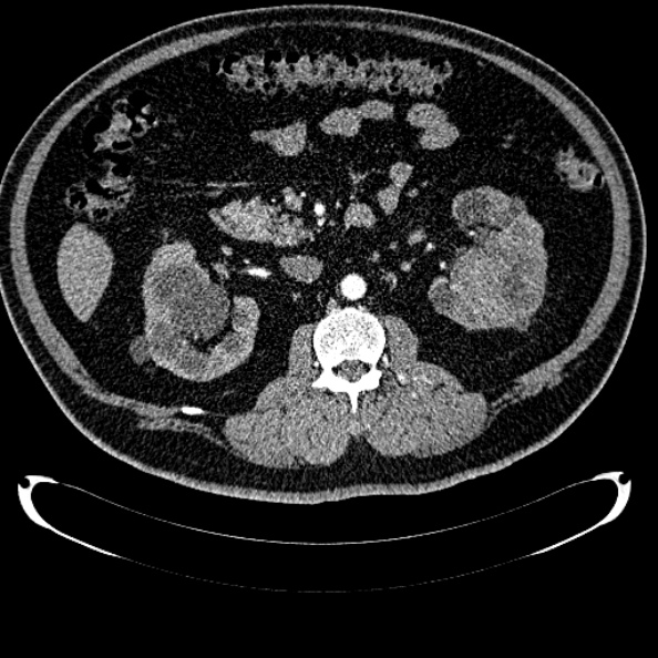 Bosniak renal cyst - type IV (Radiopaedia 24244-24518 B 150).jpg