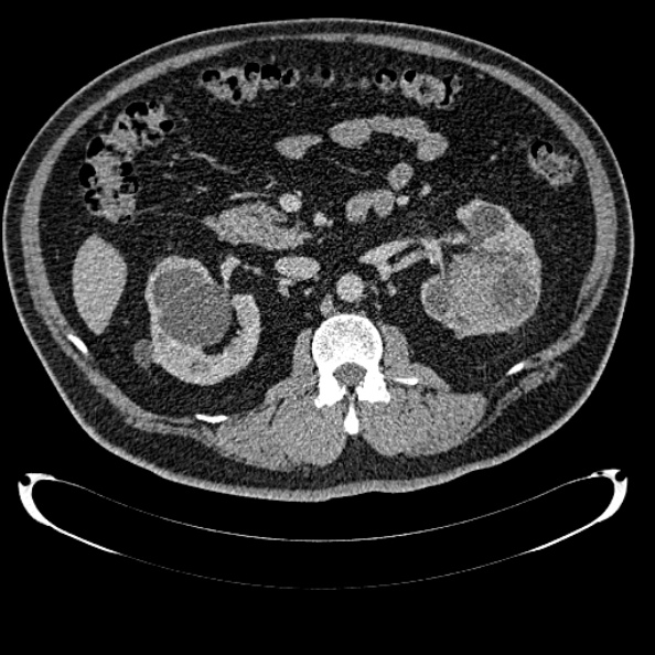 Bosniak renal cyst - type IV (Radiopaedia 24244-24518 C 144).jpg
