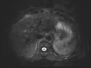 File:Bouveret syndrome (Radiopaedia 61017-68856 Axial MRCP 11).jpg