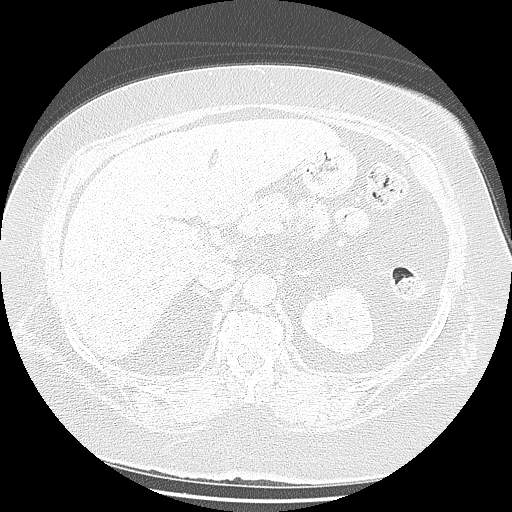 Bovine aortic arch - right internal mammary vein drains into the superior vena cava (Radiopaedia 63296-71875 Axial lung window 192).jpg
