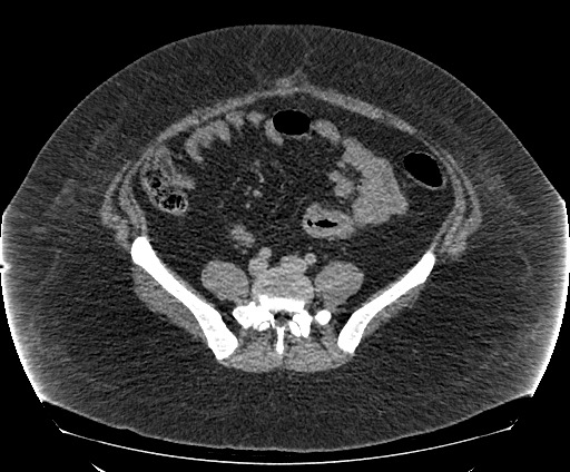 Bowel and splenic infarcts in acute lymphocytic leukemia (Radiopaedia 61055-68913 A 87).jpg