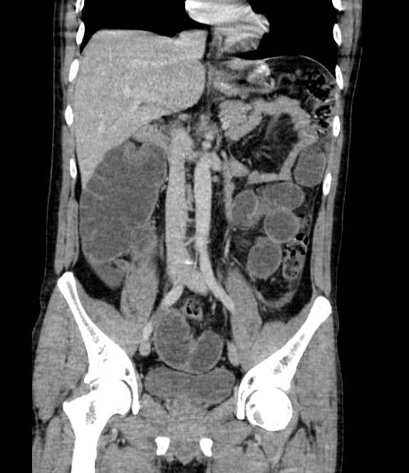 Bowel obstruction from colon carcinoma (Radiopaedia 22995-23028 C 38).jpg