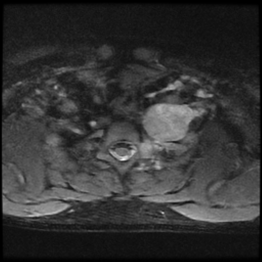 File:Brachial plexus neurofibroma (Radiopaedia 28030-28291 Axial STIR 5).png
