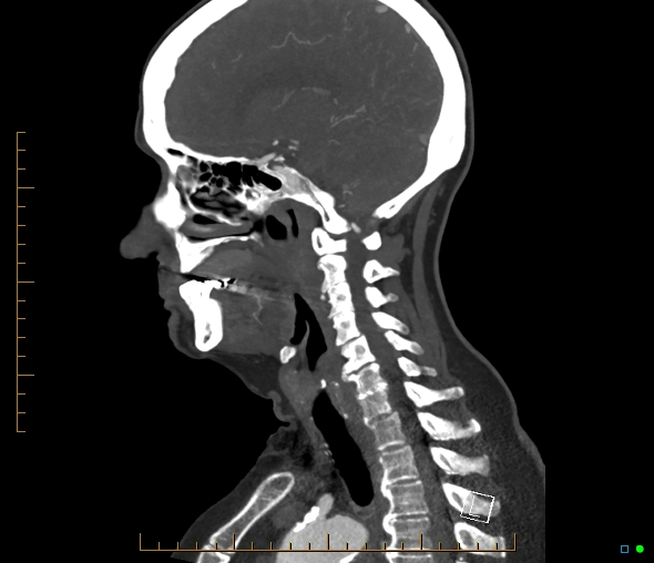 Brachiocephalic trunk stenosis (Radiopaedia 87242-103519 C 29).jpg