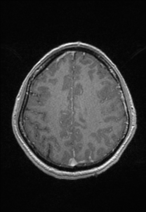 Brain abscess with ventriculitis (Radiopaedia 85703-101495 Axial T1 C+ 129).jpg