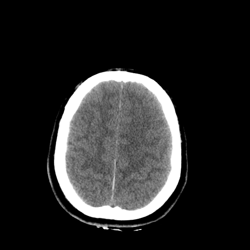 File:Brain contusions, internal carotid artery dissection and base of skull fracture (Radiopaedia 34089-35339 Axial non-contrast 38).png