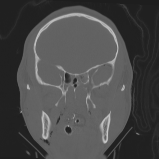 File:Brain contusions, internal carotid artery dissection and base of skull fracture (Radiopaedia 34089-35339 Coronal bone window 28).png
