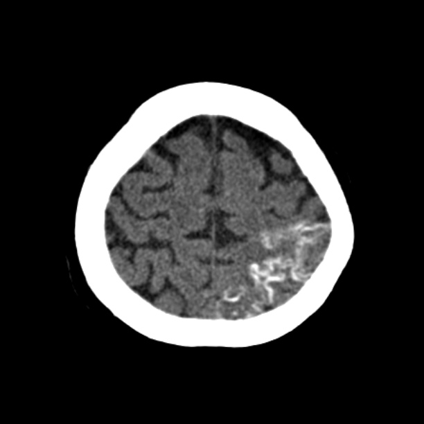 Brain cortical laminar necrosis (Radiopaedia 25822-25971 Axial non-contrast 39).jpg