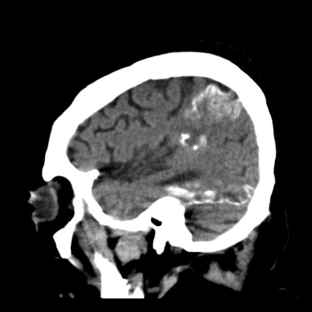 Brain cortical laminar necrosis (Radiopaedia 25822-25971 non-contrast 39).jpg