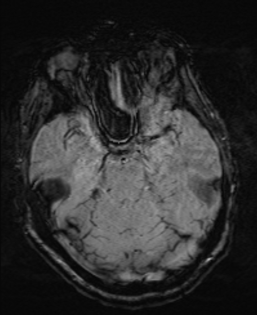 Brain metastases - lung cancer primary (Radiopaedia 75060-86115 Axial SWI 23).jpg