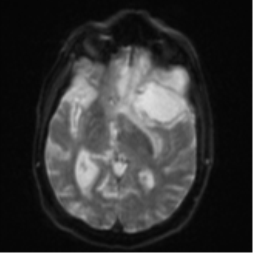 File:Brain metastasis (lung cancer) (Radiopaedia 48289-53179 Axial DWI 13).png