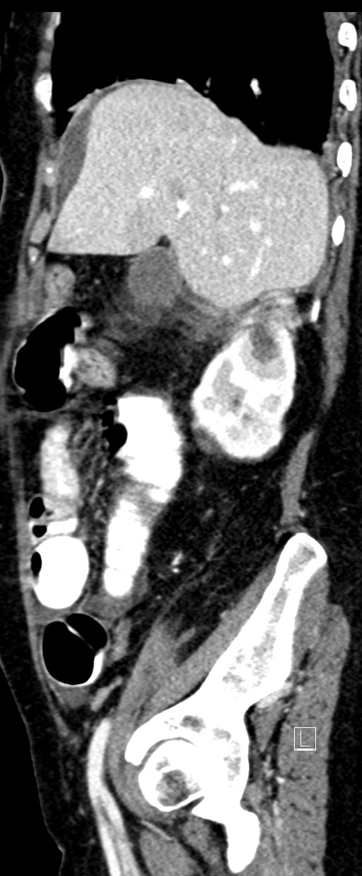 Broad ligament hernia (Radiopaedia 84802-100276 C 61).jpg