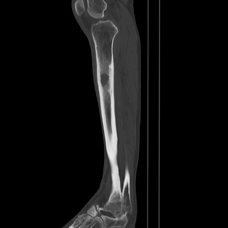 Brodie abscess - tibia (Radiopaedia 66028-75204 Sagittal bone window 37).jpg