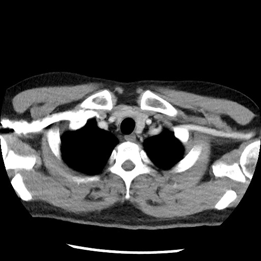 File:Bronchial carcinoid tumor (Radiopaedia 67377-76764 A 10).jpg
