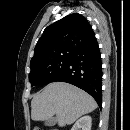 Bronchial carcinoid tumor (Radiopaedia 67377-76764 E 21).jpg