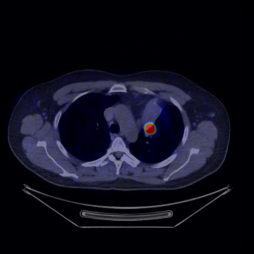 Bronchial carcinoid tumor (Radiopaedia 67377-76765 68Ga-DOTATATE PET-CT 25).jpg