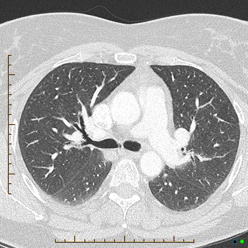 Bronchial diverticula (Radiopaedia 79512-92676 Axial lung window 73).jpg