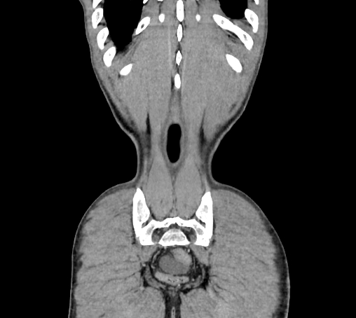 Bronchiectasis in Crohn disease (Radiopaedia 60311-67977 C 81).jpg