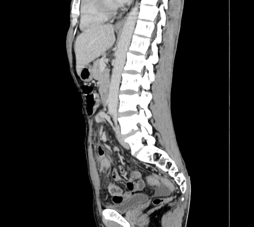 File:Bronchiectasis in Crohn disease (Radiopaedia 60311-67977 D 62).jpg