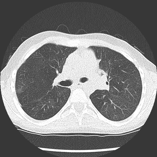 Bronchiolotis obliterans (Radiopaedia 73769-84575 Axial lung window 20).jpg