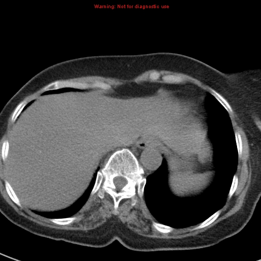 File:Bronchoalveolar carcinoma (BAC) (Radiopaedia 13436-13392 Axial non-contrast 43).jpg