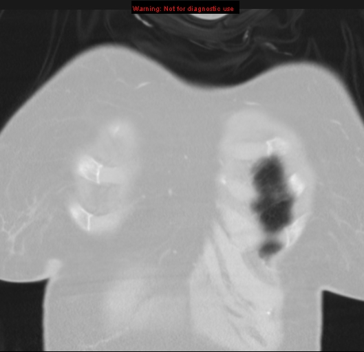 Bronchoalveolar carcinoma (BAC) (Radiopaedia 13436-13392 Coronal lung window 5).jpg