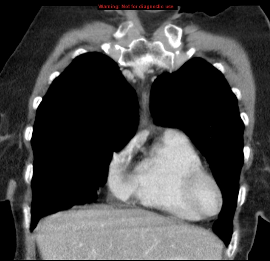 File:Bronchoalveolar carcinoma (BAC) (Radiopaedia 13436-13392 E 14).jpg