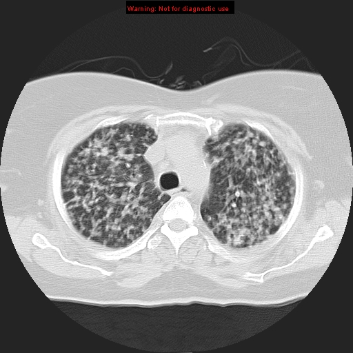Bronchoalveolar carcinoma (Radiopaedia 13224-13233 Axial lung window 14).jpg