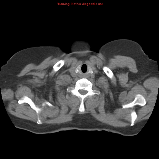 Bronchoalveolar carcinoma (Radiopaedia 13224-13233 Axial non-contrast 2).jpg