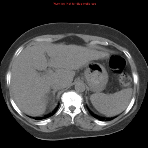 Bronchoalveolar carcinoma (Radiopaedia 13224-13233 Axial non-contrast 44).jpg