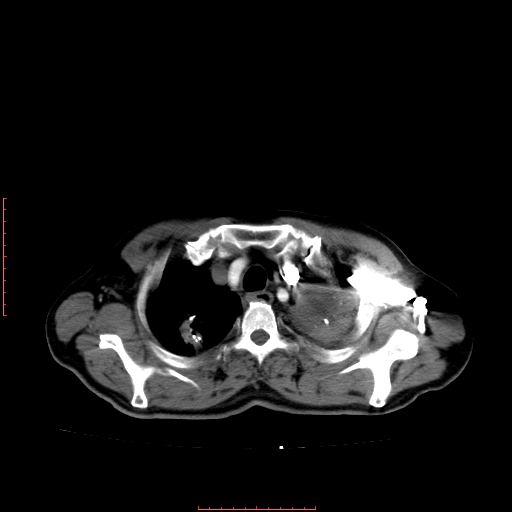 File:Bronchogenic carcinoma with left atrial large deposit - T4N3M1a (Radiopaedia 42316-45428 A 7).jpg