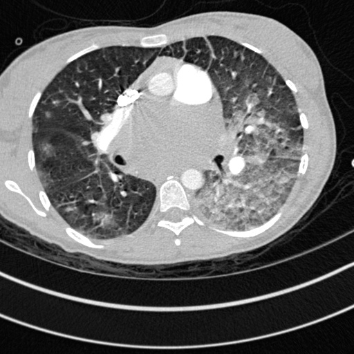 Bronchogenic cyst (Radiopaedia 77801-90071 Axial lung window 32).jpg