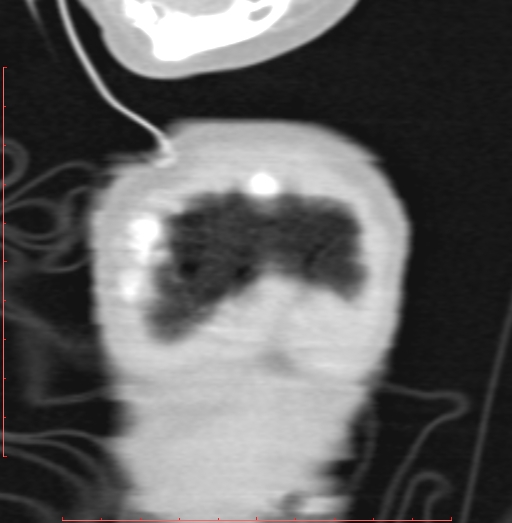 Bronchogenic cyst (Radiopaedia 78599-91409 Coronal lung window 10).jpg