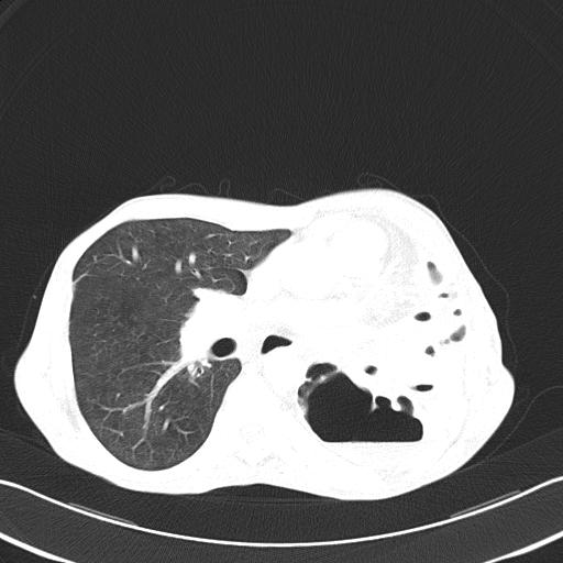 Bronchopleural fistula secondary to tuberculosis (Radiopaedia 20415-20322 Axial lung window 30).jpg