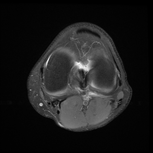 File:Bucket-handle meniscus tear (Radiopaedia 65700-74809 Axial PD fat sat 17).jpg