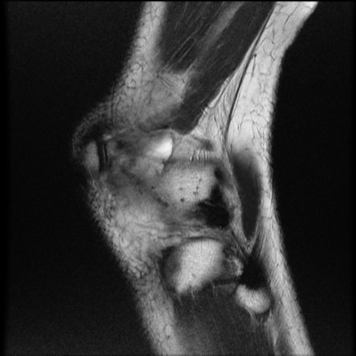 File:Bucket-handle meniscus tear (Radiopaedia 65700-74809 Sagittal T2 22).jpg