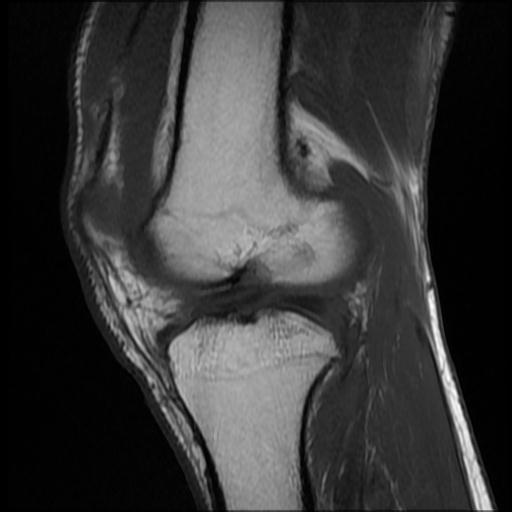 File:Bucket handle tear - medial meniscus (Radiopaedia 69245-79026 Sagittal T1 8).jpg