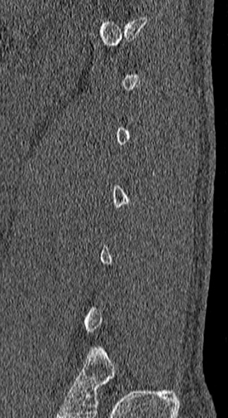 File:Burst fracture (Radiopaedia 53373-59357 Sagittal bone window 2).jpg