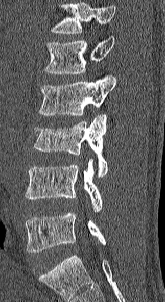 Burst fracture (Radiopaedia 53373-59357 Sagittal bone window 51).jpg
