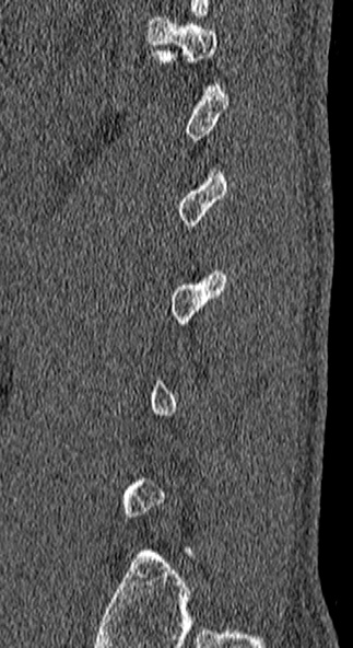File:Burst fracture (Radiopaedia 53373-59357 Sagittal bone window 8).jpg