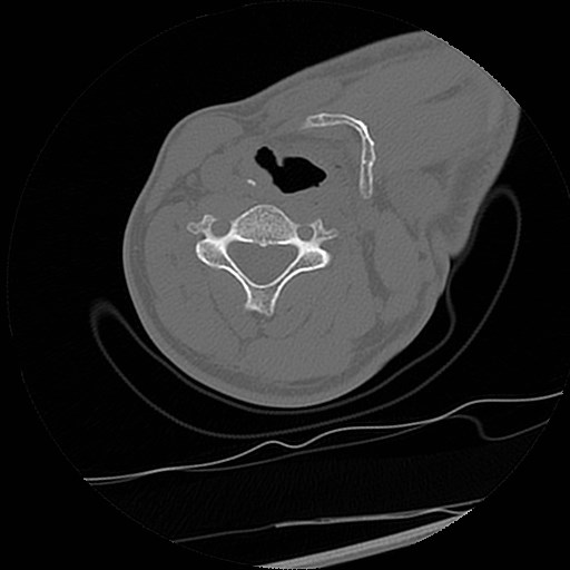 File:C1-C2 "subluxation" - normal cervical anatomy at maximum head rotation (Radiopaedia 42483-45607 Axial non-contrast 1).jpg